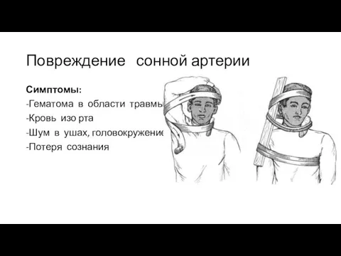 Повреждение сонной артерии Симптомы: -Гематома в области травмы -Кровь изо рта -Шум