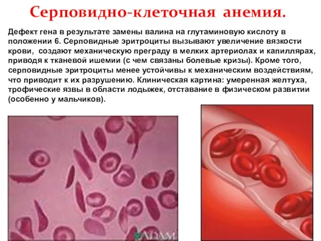 Серповидно-клеточная анемия. Дефект гена в результате замены валина на глутаминовую кислоту в