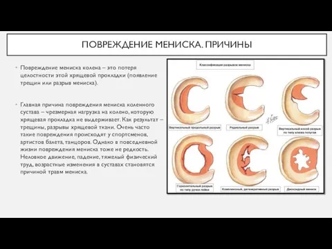 ПОВРЕЖДЕНИЕ МЕНИСКА. ПРИЧИНЫ Повреждение мениска колена – это потеря целостности этой хрящевой