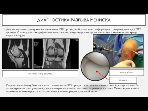 ДИАГНОСТИКА РАЗРЫВА МЕНИСКА Диагностировать травму мениска можно на УЗИ сустава, но больше