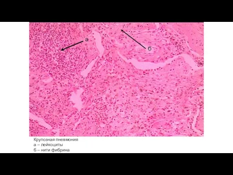 Крупозная пневмония а – лейкоциты б – нити фибрина