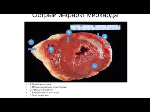 Острый инфаркт миокарда А.Левый желудочек Б.Межжелудочковая перегородка В.Правый желудочек Г.Жировая ткань эпикарда