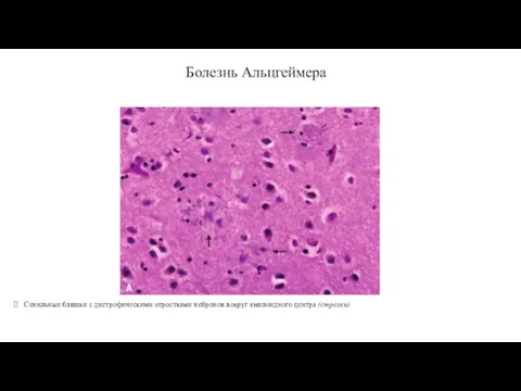 Болезнь Альцгеймера Сенильные бляшки с дистрофическими отростками нейронов вокруг амилоидного центра (стрелки)