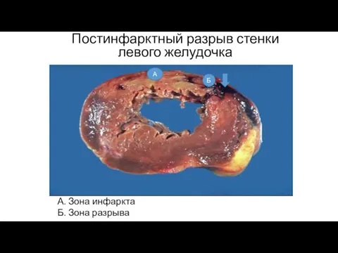 Постинфарктный разрыв стенки левого желудочка А. Зона инфаркта Б. Зона разрыва А Б
