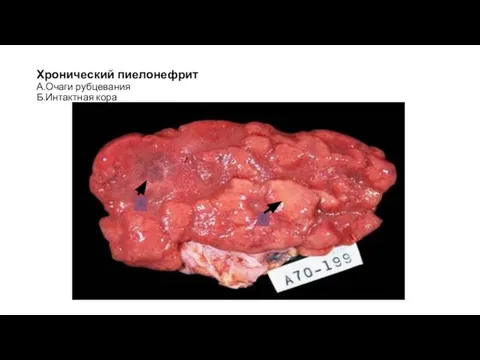Хронический пиелонефрит А.Очаги рубцевания Б.Интактная кора А Б