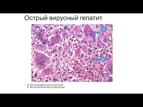 Острый вирусный гепатит А. Регенерирующий гепатоцит Б. Воспалительный инфильтрат А Б