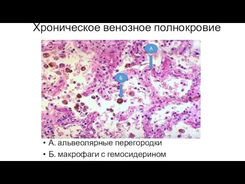 Хроническое венозное полнокровие А. альвеолярные перегородки Б. макрофаги с гемосидерином А Б