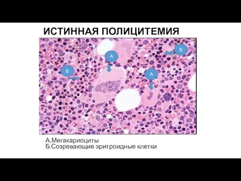ИСТИННАЯ ПОЛИЦИТЕМИЯ А.Мегакариоциты Б.Созревающие эритроидные клетки А А Б Б