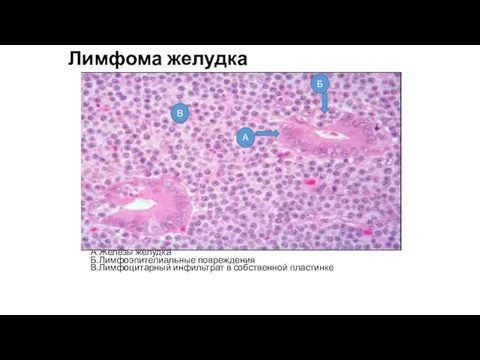 Лимфома желудка А.Железы желудка Б.Лимфоэпителиальные повреждения В.Лимфоцитарный инфильтрат в собственной пластинке В Б А