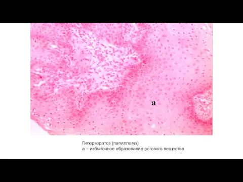 Гиперкератоз (папиллома) а – избыточное образование рогового вещества
