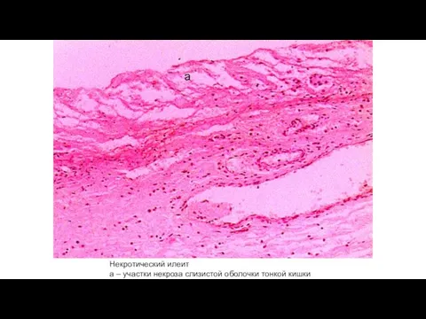 Некротический илеит а – участки некроза слизистой оболочки тонкой кишки