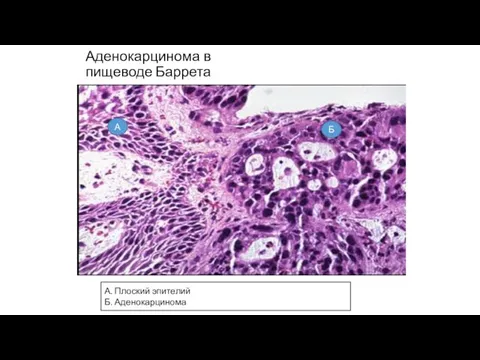 Аденокарцинома в пищеводе Баррета А Б А. Плоский эпителий Б. Аденокарцинома