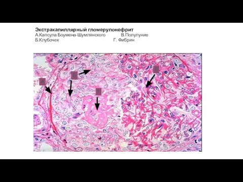 Экстракапиллярный гломерулонефрит А.Капсула Боумена-Шумлянского В.Полулуние Б.Клубочек Г. Фибрин А В Г Б