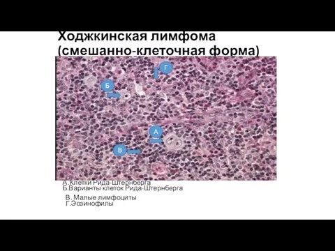 Ходжкинская лимфома (смешанно-клеточная форма) А..Клетки Рида-Штернберга Б.Варианты клеток Рида-Штернберга В. Малые лимфоциты