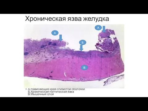 Хроническая язва желудка А.Нависающие края слизистой оболочки Б.Хроническая пептическая язва В.Мышечный слой А А Б В