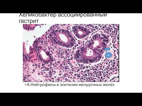 Хеликобактер ассоциированный гастрит А.Нейтрофилы в эпителии желудочных желез А