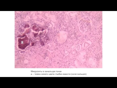 Микролиты в канальцах почки а – темно-синего цвета глыбки извести (соли кальция)