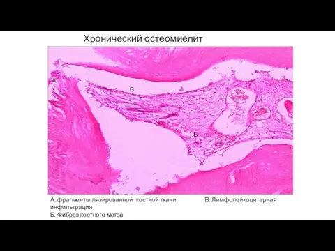 Хронический остеомиелит А. фрагменты лизированной костной ткани В. Лимфолейкоцитарная инфильтрация Б. Фиброз