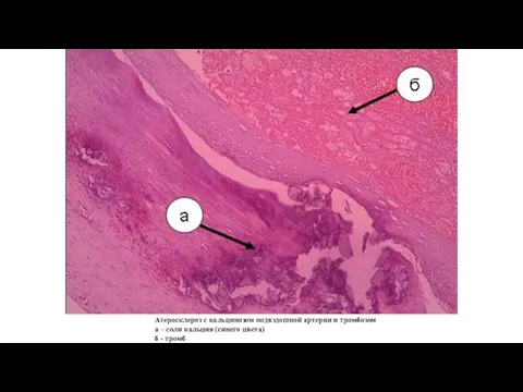 Атеросклероз с кальцинозом подвздошной артерии и тромбозом а – соли кальция (синего цвета) б - тромб