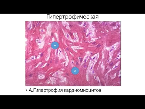 Гипертрофическая кардиомиопатия А.Гипертрофия кардиомиоцитов А А