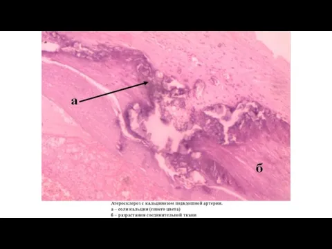 Атеросклероз с кальцинозом подвдошной артерии. а – соли кальция (синего цвета) б – разрастания соединительной ткани