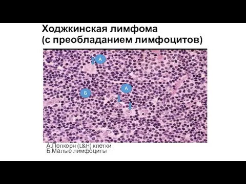 Ходжкинская лимфома (с преобладанием лимфоцитов) А.Попкорн (L&H) клетки Б.Малые лимфоциты А А Б