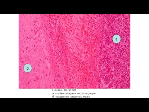 Гнойный менингит а - лейкоцитарная инфильтрация б - вещество головного мозга
