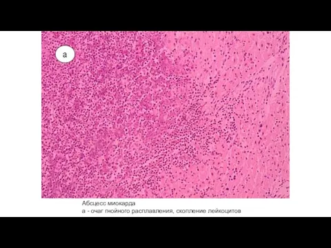 Абсцесс миокарда а - очаг гнойного расплавления, скопление лейкоцитов
