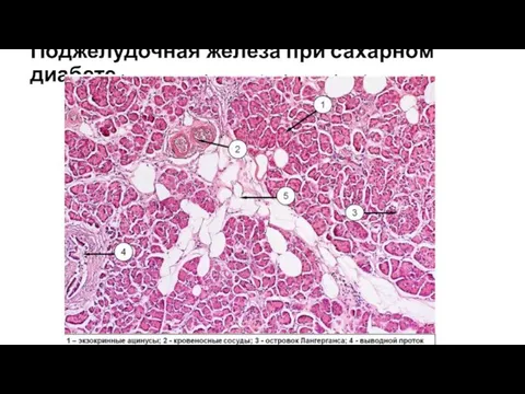 Поджелудочная железа при сахарном диабете.