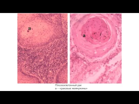 Плоскоклеточный рак а – «раковые жемчужины»