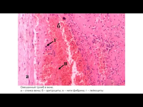 Смешанный тромб в вене. а – стенка вены; б – зритроциты; в