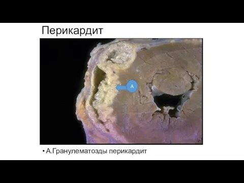 Перикардит А.Гранулематозды перикардит А