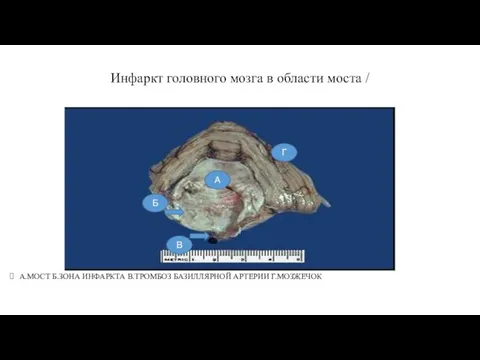 Инфаркт головного мозга в области моста / А.МОСТ Б.ЗОНА ИНФАРКТА В.ТРОМБОЗ БАЗИЛЛЯРНОЙ