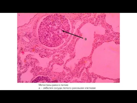 Метастазы рака в легкие а – эмболия сосуда легкого раковыми клетками