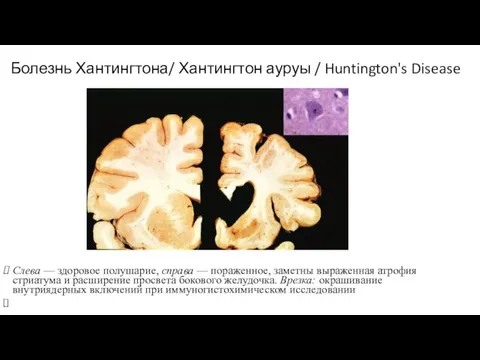 Болезнь Хантингтона/ Хантингтон ауруы / Huntington's Disease Слева — здоровое полушарие, справа