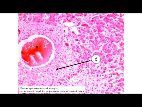 Печень при механической желтухе а – желчный тромб; б – разрастания соединительной ткани