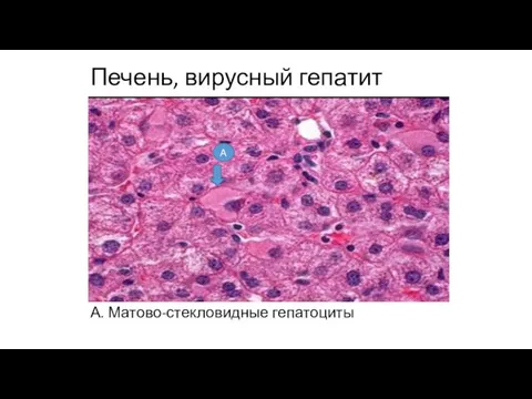 Печень, вирусный гепатит А. Матово-стекловидные гепатоциты А
