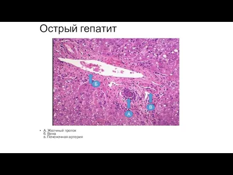 Острый гепатит А. Желчный проток б. Вена в. Печеночная артерия В А Б