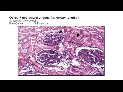 Острый постинфекционный гломерулонефрит А. Дольчатые структуры Б.Клубочки В.Канальцы А Б В