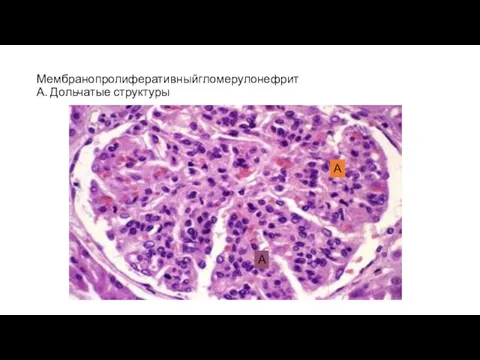 Мембранопролиферативныйгломерулонефрит А. Дольчатые структуры А А