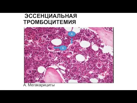 ЭССЕНЦИАЛЬНАЯ ТРОМБОЦИТЕМИЯ А. Мегакарициты А А