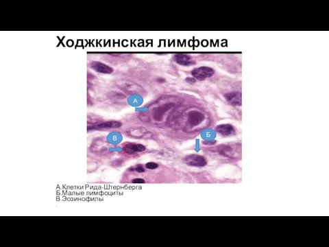 Ходжкинская лимфома А.Клетки Рида-Штернберга Б.Малые лимфоциты В.Эозинофилы В Б А