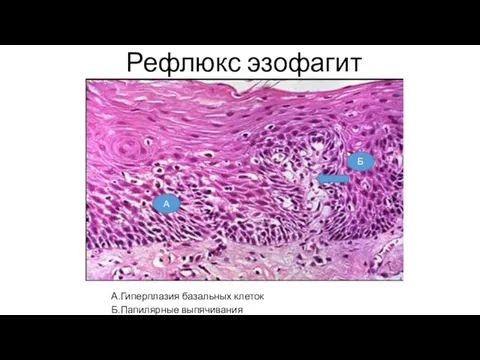 Рефлюкс эзофагит А.Гиперплазия базальных клеток Б.Папилярные выпячивания А Б