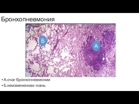 Бронхопневмония А.очаг бронхопневмонии Б.неизмененная ткань Б А