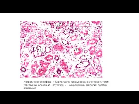 Некротический нефроз. 1-Кариолизис, плазморексис клеткок эпителия извитых канальцев. 2 – клубочек, 3