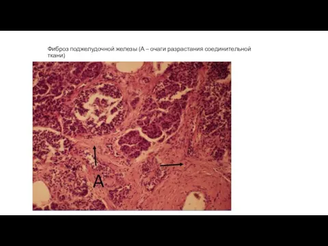 Фиброз поджелудочной железы (А – очаги разрастания соединительной ткани)