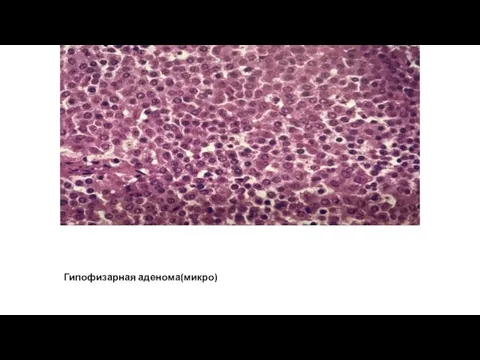 Гипофизарная аденома(микро)