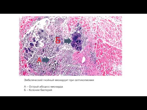 Эмболический гнойный миокардит при септикопиемии А – Острый абсцесс миокарда Б – Колонии бактерий А Б