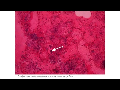 Стафилококковая пневмония: а – колонии микробов а