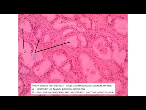 Нодулярная железистая гиперплазия предстательной железы а – железистые трубки разного диаметра б
